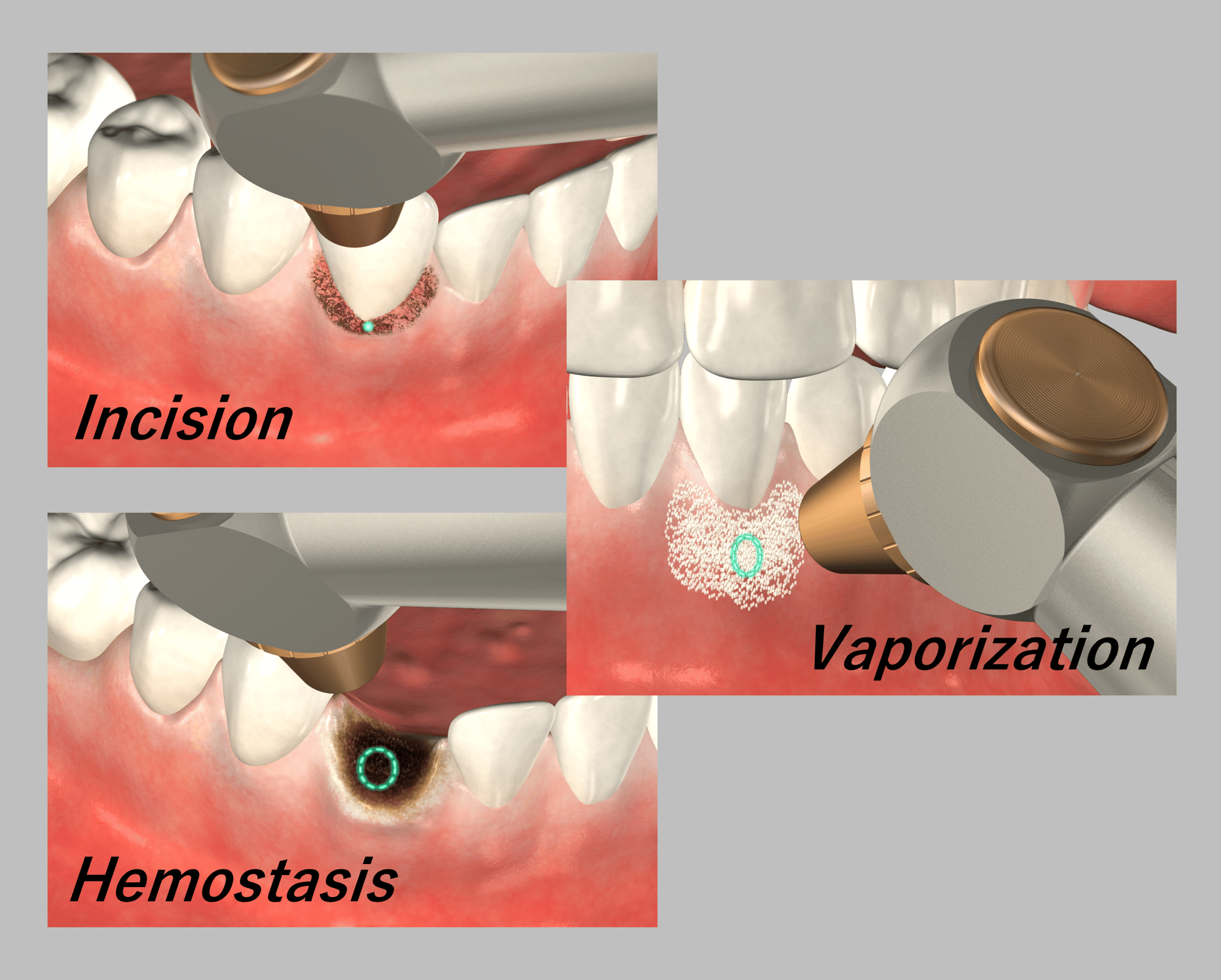レーザーでできること